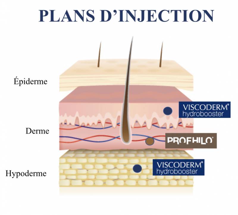 Profhilo Viscoderm Profhydro skinbooster hydrobooster acide hyaluronique Paris 6